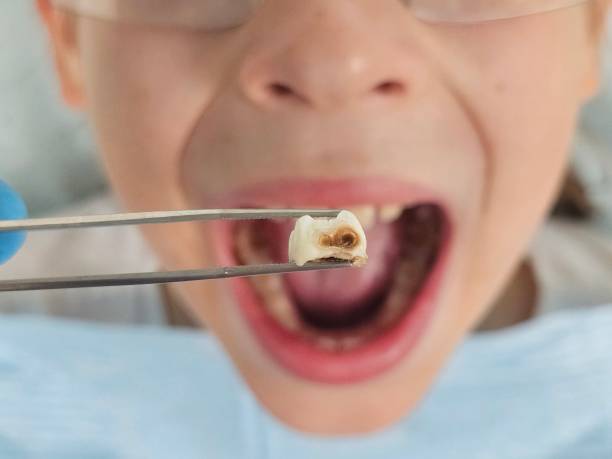 Best Chipped Tooth Repair Near Me  in Tarpon Springs, FL